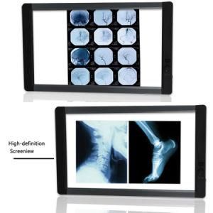 Medical LED X Ray Negatoscope LED Viewer